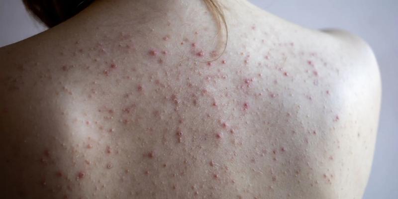 Naturalne składniki na trądzik