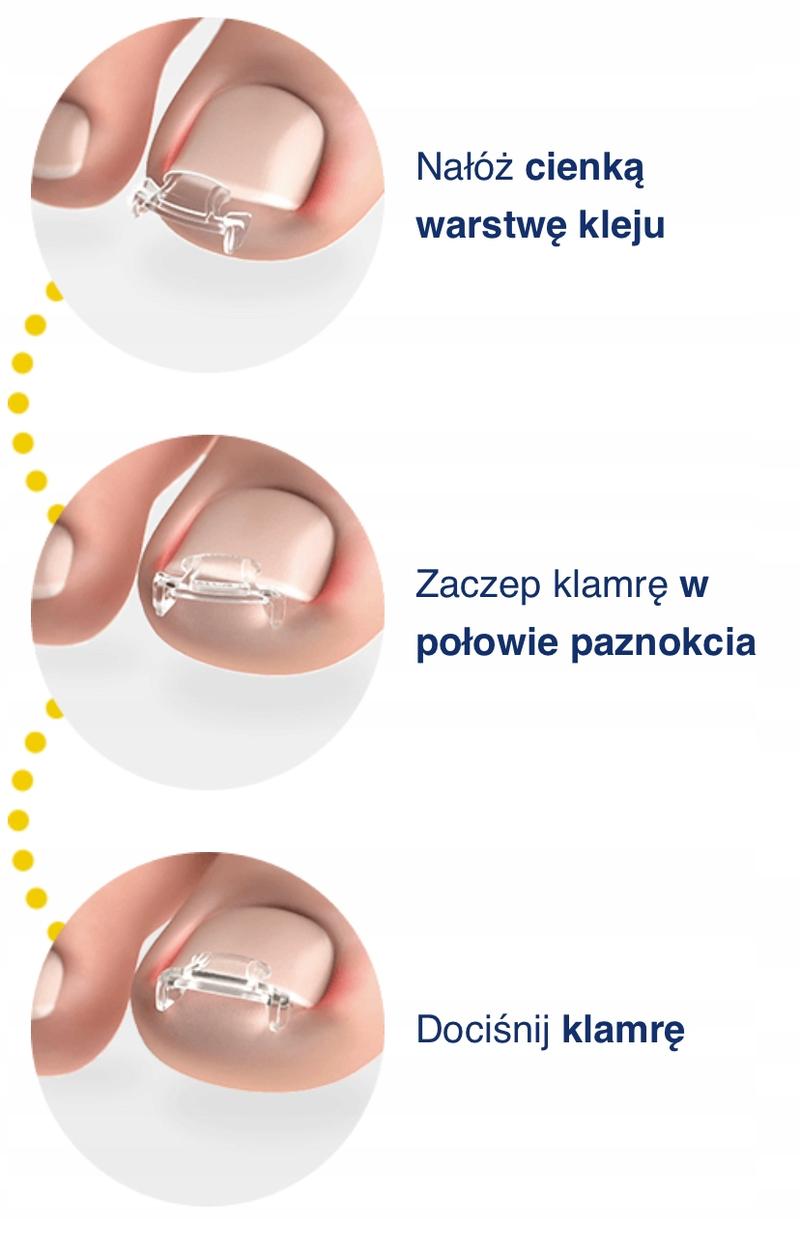 Klamry na wrastające paznokcie