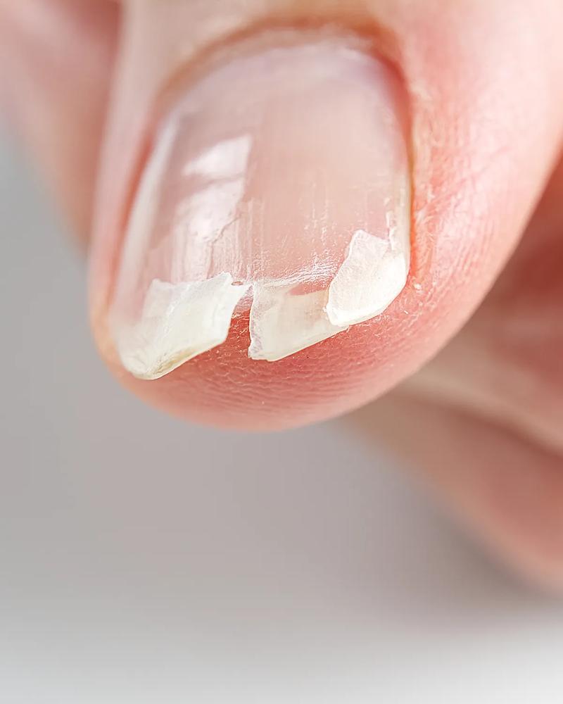 Odrastający paznokieć