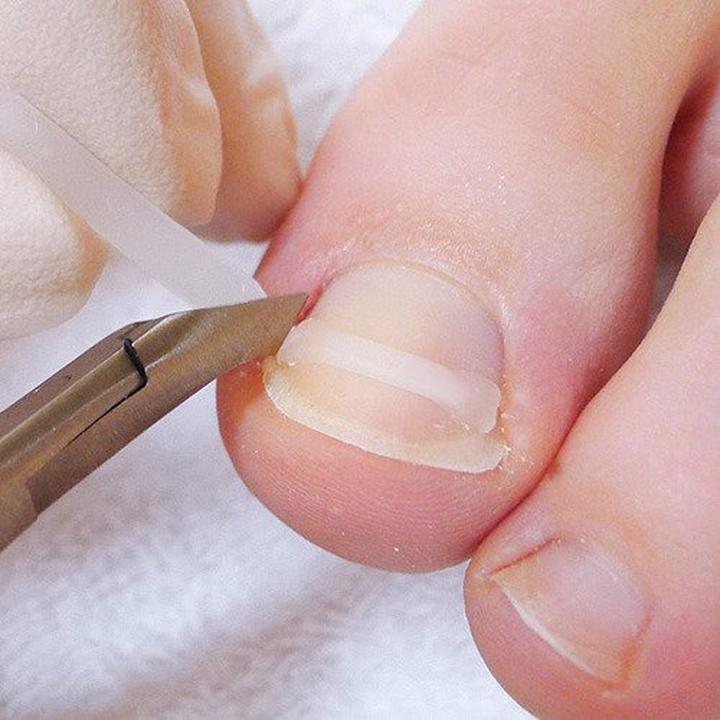 Skuteczność klamer na paznokcie