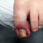 Czy zszedł mi paznokieć? Oto, co musisz wiedzieć o jego odroście