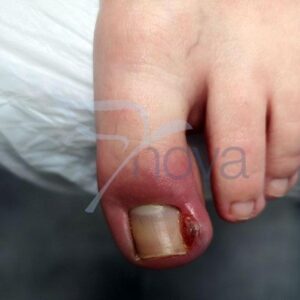 Czy zszedł mi paznokieć? Oto, co musisz wiedzieć o jego odroście