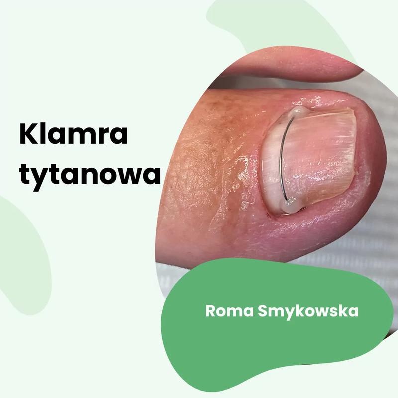 Jak skuteczne są klamry na paznokcie? Odkryj prawdę o ich działaniu