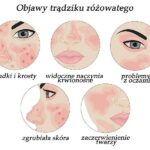 Jakie kosmetyki wybrać w walce z trądzikiem różowatym?