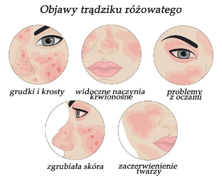 Jakie kosmetyki wybrać w walce z trądzikiem różowatym?