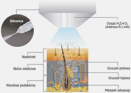 Mezoterapia bezigłowa: jakie kosmetyki warto stosować?
